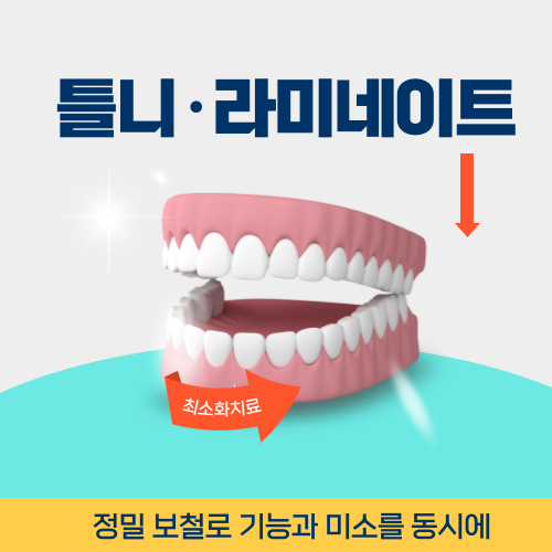 부천치과 틀니, 라미네이트